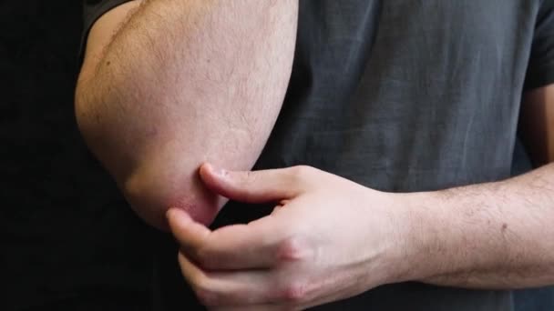Man Scratches Rough Patch Skin His Elbow Seasonal Skin Problem — Stock Video