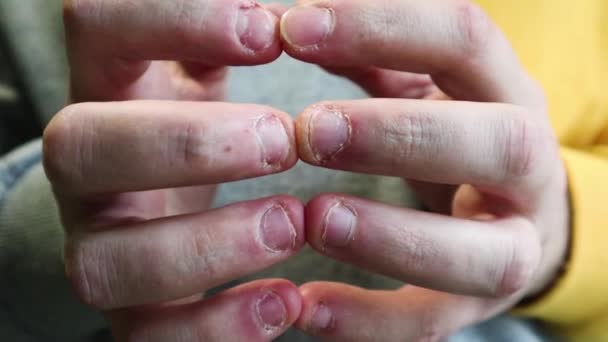 Dedos Feos Ugryzienie Uñas Mordidas Cutículas Heridas Los Dedos Hábito — Vídeo de stock