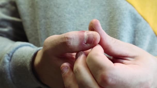 Уродливые Уродливые Пальцы Грызущие Ногти Кутикулы Раны Пальцах Привычка Грызть — стоковое видео