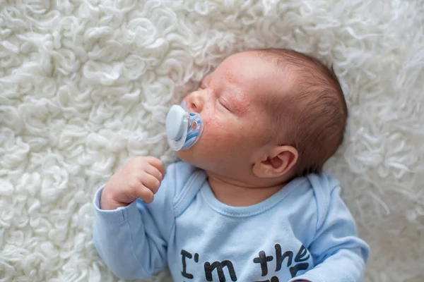 Kleine pasgeboren baby slapen, baby met scin uitslag — Stockfoto