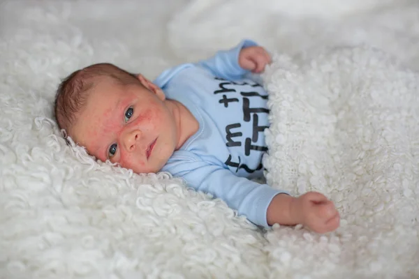 Novorozené miminko spící, baby s kožní vyrážkou — Stock fotografie