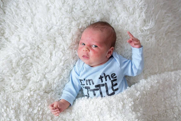 Little newborn baby sleeping, baby with skin rash — Stock Photo, Image