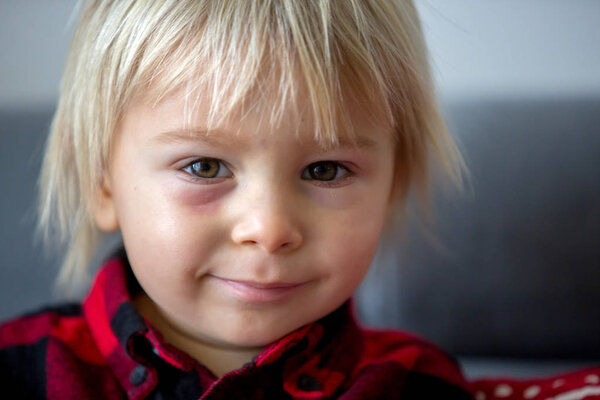 Blonde baby ddler boy with red burned spot under the eye, feeling p
