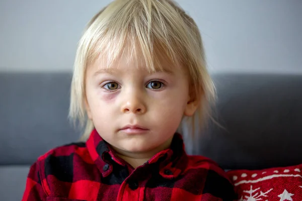 Blonde toddler boy with red burned spot under the eye, feeling p — Stock Photo, Image