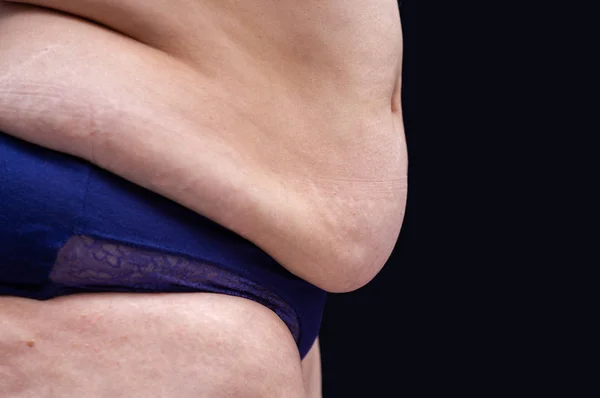 Vientre femenino gordo con celulitis — Foto de Stock