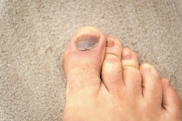 finger disease. hematoma. toe injury. bruise and trauma treatment. medical intervention required. fracture. uncomfortable footwear. nail fungus. healthy feet. Medicine concept. Trauma foot toes nails