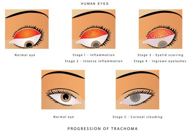 Trachoma of the eye clipart