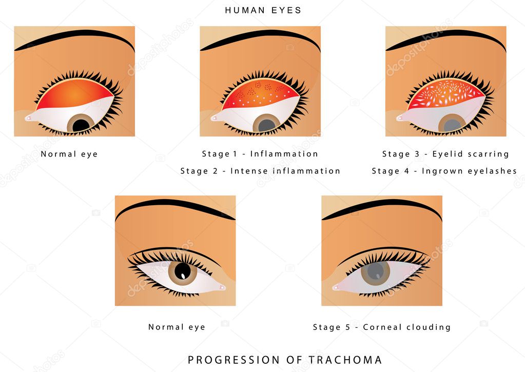 Trachoma of the eye