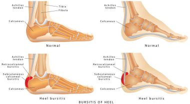 Heel Bursitis (Foot) clipart