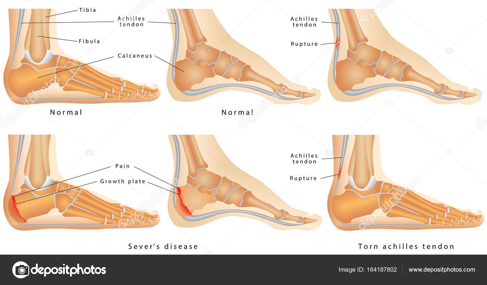 Squeeze test Severs Heel Pain — Kidzoles Orthotics for Kids