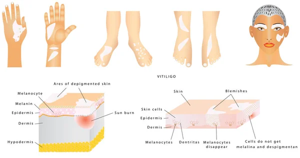 Vitiligo-피부 상태 — 스톡 벡터