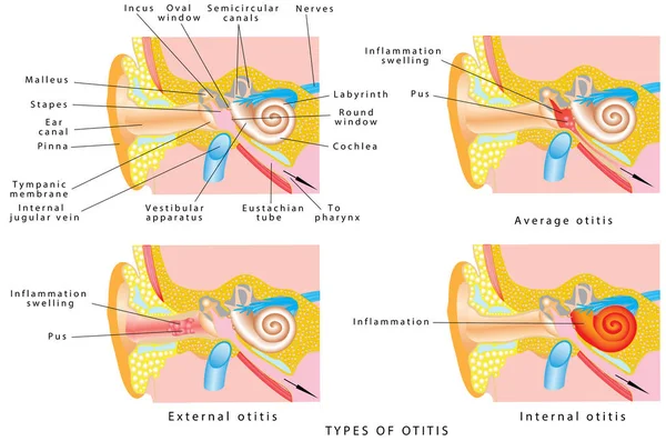 Tipos de otitis — Vector de stock