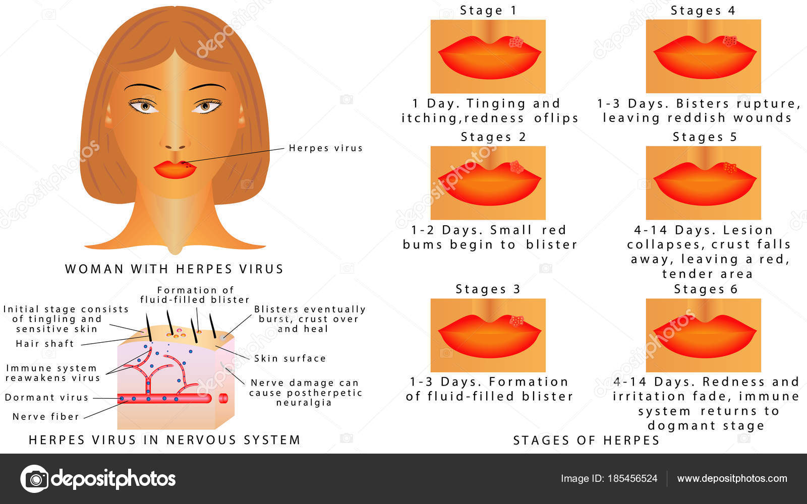 Vektorgrafiken Herpes Simplex Vektorbilder Herpes Simplex Depositphotos