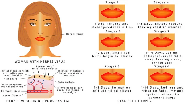 唇にヘルペス ウイルス感染 唇にヘルペス ウイルスの段階 唇の炎症 神経系におけるヘルペス ウイルス 白い背景の上のヘルペス ウイルスを持つ女性 — ストックベクタ
