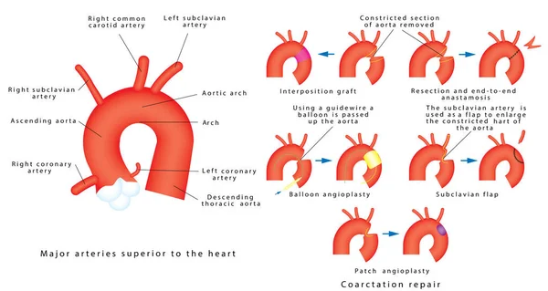 Coarctation Tamir Aortun Coarktasyonu Aortun Konjenital Kusuru Aort Kemerinin Daralması — Stok Vektör