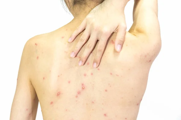 Beyaz üzerine Varisella virüs ya da Tavuk Pox'u arkasında kız closeup 