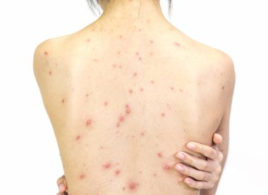 Beyaz üzerine Varisella virüs ya da Tavuk Pox'u arkasında kız closeup 