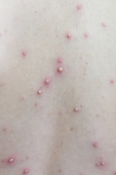 Primo piano della schiena ragazza del virus della varicella o della varicella . — Foto Stock