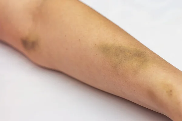 Erkek istismarından sonra kadın eli morarmış..