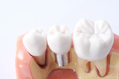 Generic dental teeth model  clipart