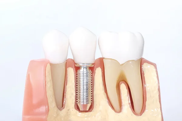 Γενική οδοντιατρική δόντια μοντέλο — Φωτογραφία Αρχείου