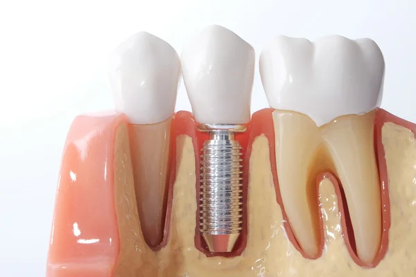 Modello dentale generico — Foto Stock