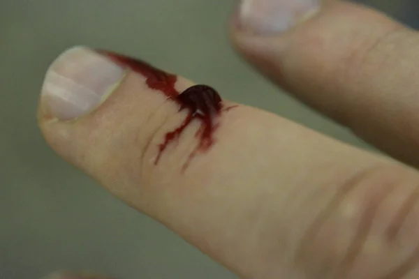 Parmağında kanama var.. 