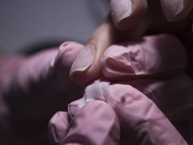 The manicurist treats the wound with a cotton pad. Cut on the finger near the nail close-up. The manicurist injured a client.