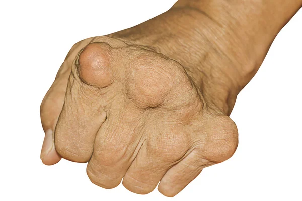 Eklem ağrısı, kemik ağrısı, gut, romatizma semptomları, radyoaktif hastalık, erkek osteoporozu, yaralı kemik, yaralanma, ağrı, eklem iltihabı, kol, diz, diz, beyaz arka plan.