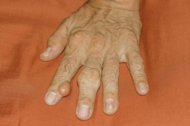 Eklem ağrısı, kemik ağrısı, gut, romatizma semptomları, radyoaktif hastalık, erkek osteoporozu, yaralı kemik, yaralanma, ağrı, eklem iltihabı, kol, diz, diz