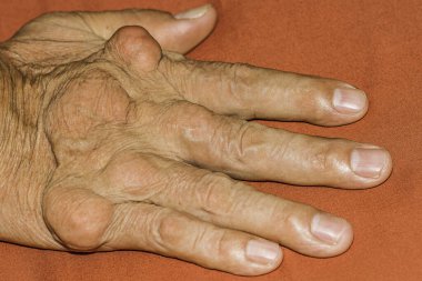 Eklem ağrısı, kemik ağrısı, gut, romatizma semptomları, radyoaktif hastalık, erkek osteoporozu, yaralı kemik, yaralanma, ağrı, eklem iltihabı, kol, diz, diz