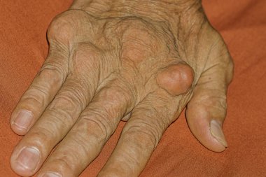 Eklem ağrısı, kemik ağrısı, gut, romatizma semptomları, radyoaktif hastalık, erkek osteoporozu, yaralı kemik, yaralanma, ağrı, eklem iltihabı, kol, diz, diz