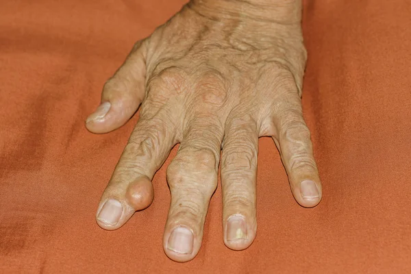 Eklem ağrısı, kemik ağrısı, gut, romatizma semptomları, radyoaktif hastalık, erkek osteoporozu, yaralı kemik, yaralanma, ağrı, eklem iltihabı, kol, diz, diz