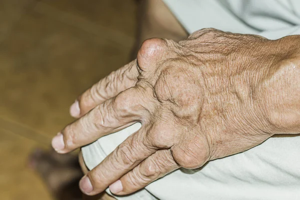 Severe Gout Men Suffering Joint Pain Bone Pain Gout Rheumatoid — Stock Photo, Image