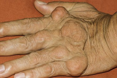 Eklem ağrısı, kemik ağrısı, gut, romatizma semptomları, radyoaktif hastalık, erkek osteoporozu, yaralı kemik, yaralanma, ağrı, eklem iltihabı, kol, diz, diz