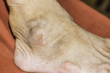 Eklem ağrısı, kemik ağrısı, gut, romatizma semptomları, radyoaktif hastalık, erkek osteoporozu, yaralı kemik, yaralanma, ağrı, eklem iltihabı, kol, diz, diz