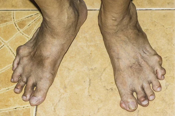 Eklem ağrısı, kemik ağrısı, gut, romatizma semptomları, radyoaktif hastalık, erkek osteoporozu, yaralı kemik, yaralanma, ağrı, eklem iltihabı, kol, diz, diz