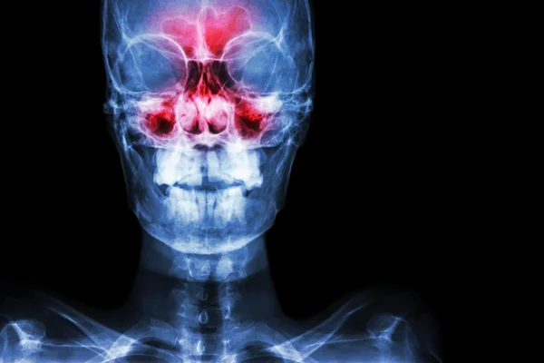 Nebenhöhlenentzündung. Film-Röntgenschädel (anterior - posterior) zeigen Infektionen und Entzündungen an Stirnhöhle, Stirnhöhle, Kieferhöhle und Blindbereich rechts — Stockfoto