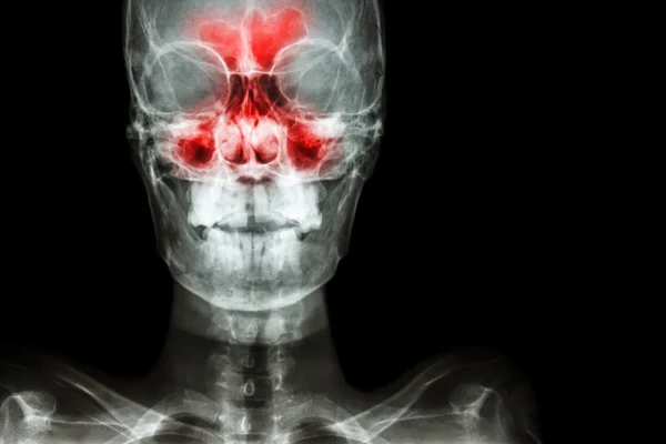 Sinusitis. film x-ray skull AP ( anterior - posterior ) show infection and inflammation at frontal sinus , ethmoid sinus , maxillary sinus and blank area at right side — Stock Photo, Image