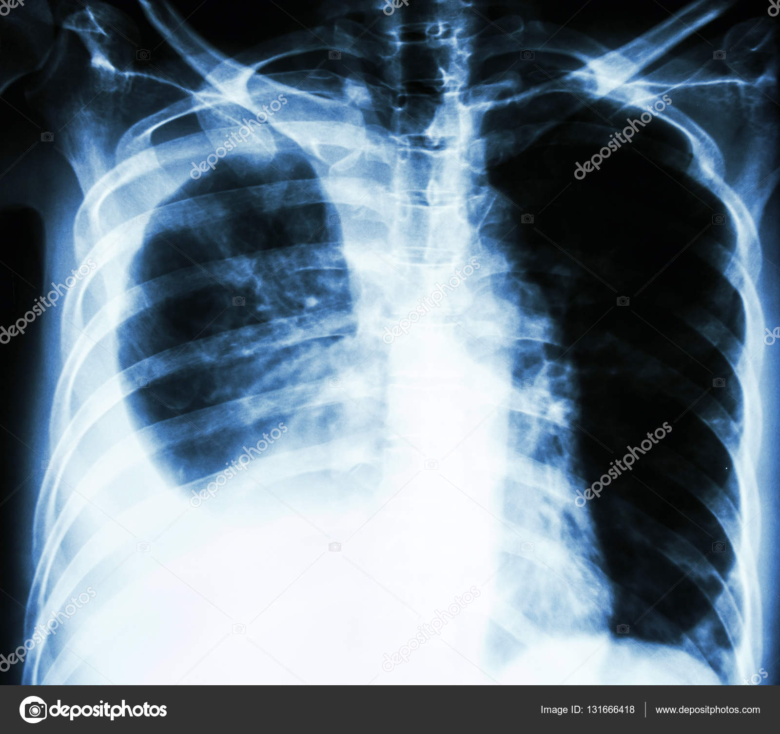 Derrame pleural en ingles