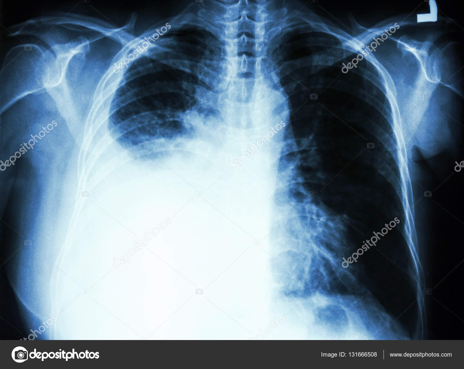 Pleural ingles derrame en