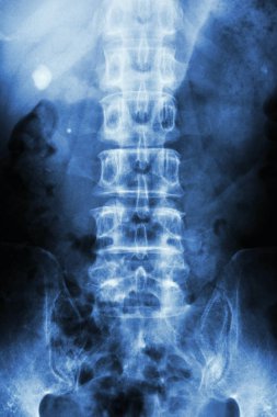 film x-ray Kub ( Böbrek - üreter - mesane ) göstermek sağ böbrek taşı ( sol tarafta yuvarlak şekil )