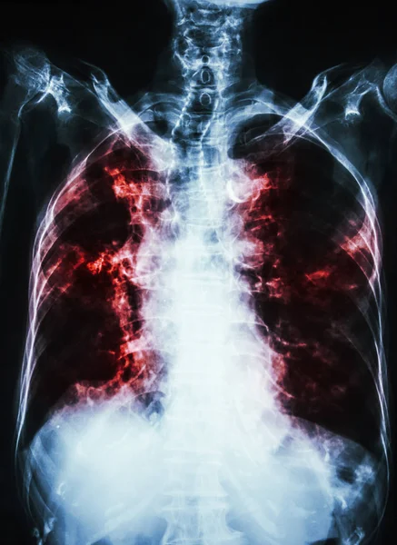 Pulmonary Tuberculosis . film chest x-ray of old patient show interstitial infiltration both lung and calcification at trachea ( can seen shape of trachea ) — Stock Photo, Image