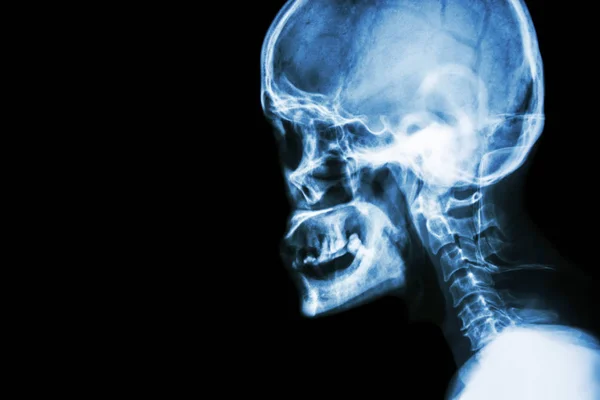 Rayos X de película La vista lateral del cráneo muestra el cráneo normal del ser humano y la columna cervical y el área en blanco en el lado izquierdo —  Fotos de Stock