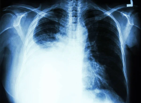 Pleurális folyadékgyülem, tüdőrák miatt — Stock Fotó