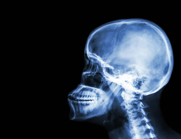 Плівковий рентгенівський череп і шийний хребет вид збоку. порожня ділянка ліворуч — стокове фото