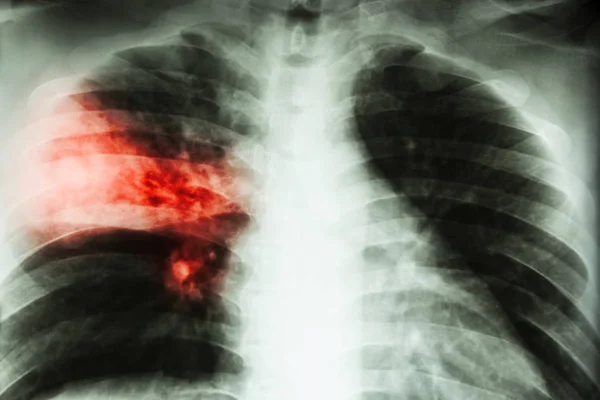 Pneumonia lobar. radiografia de tórax mostra infiltração alveolar no lobo médio direito devido à infecção por tuberculose  . — Fotografia de Stock