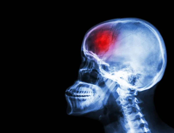 Udar mózgu. film RTG czaszki i kręgosłupa szyjnego bocznym widokiem i udaru mózgu. udar mózgu. pusty obszar po lewej stronie . — Zdjęcie stockowe