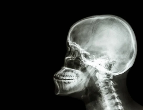 Kalvo röntgenkuva kallo ja kohdunkaulan selkärangan sivusuunnassa näkymä. tyhjä alue vasemmalla puolella — kuvapankkivalokuva