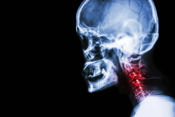 Spondilosi cervicale. pellicola radiografia cranio vista laterale e dolore al collo  . — Foto Stock